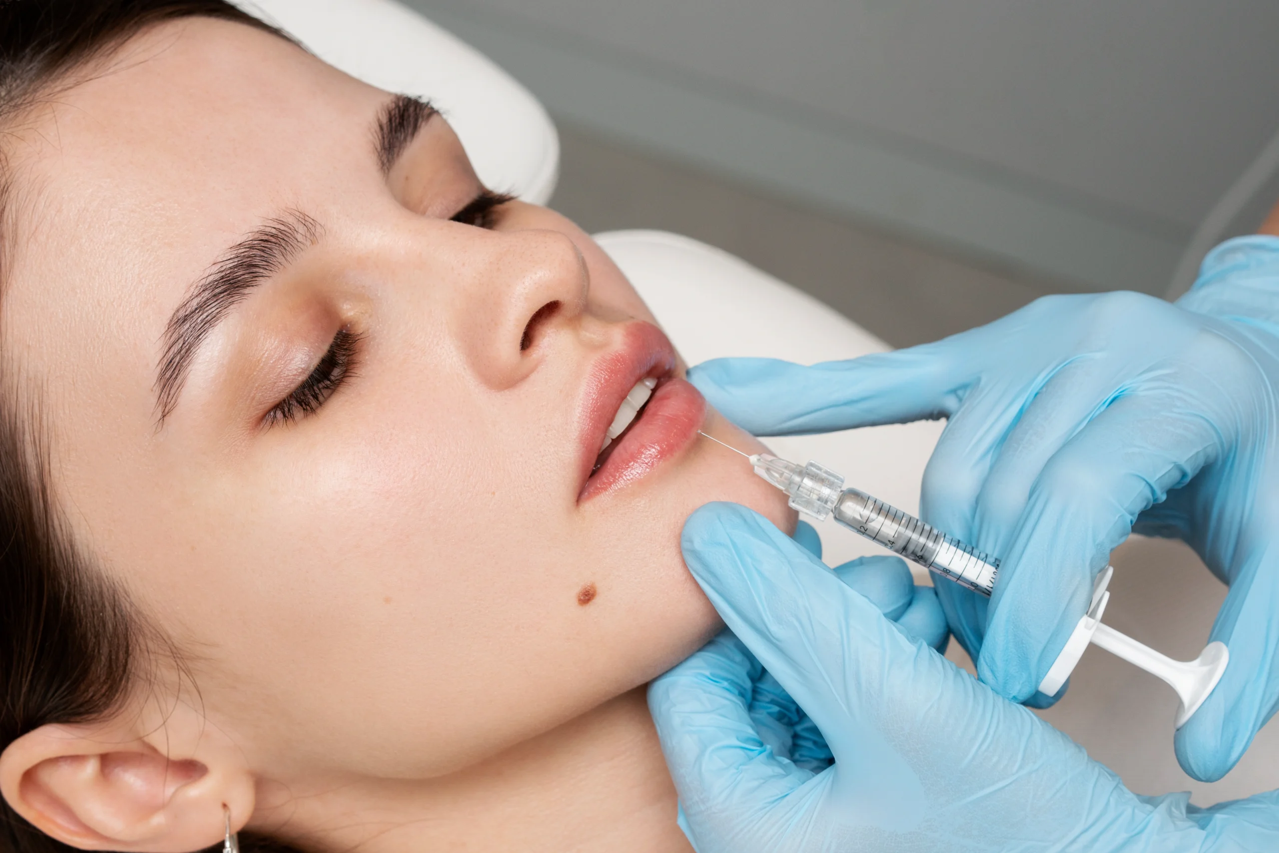 dermal lip filler