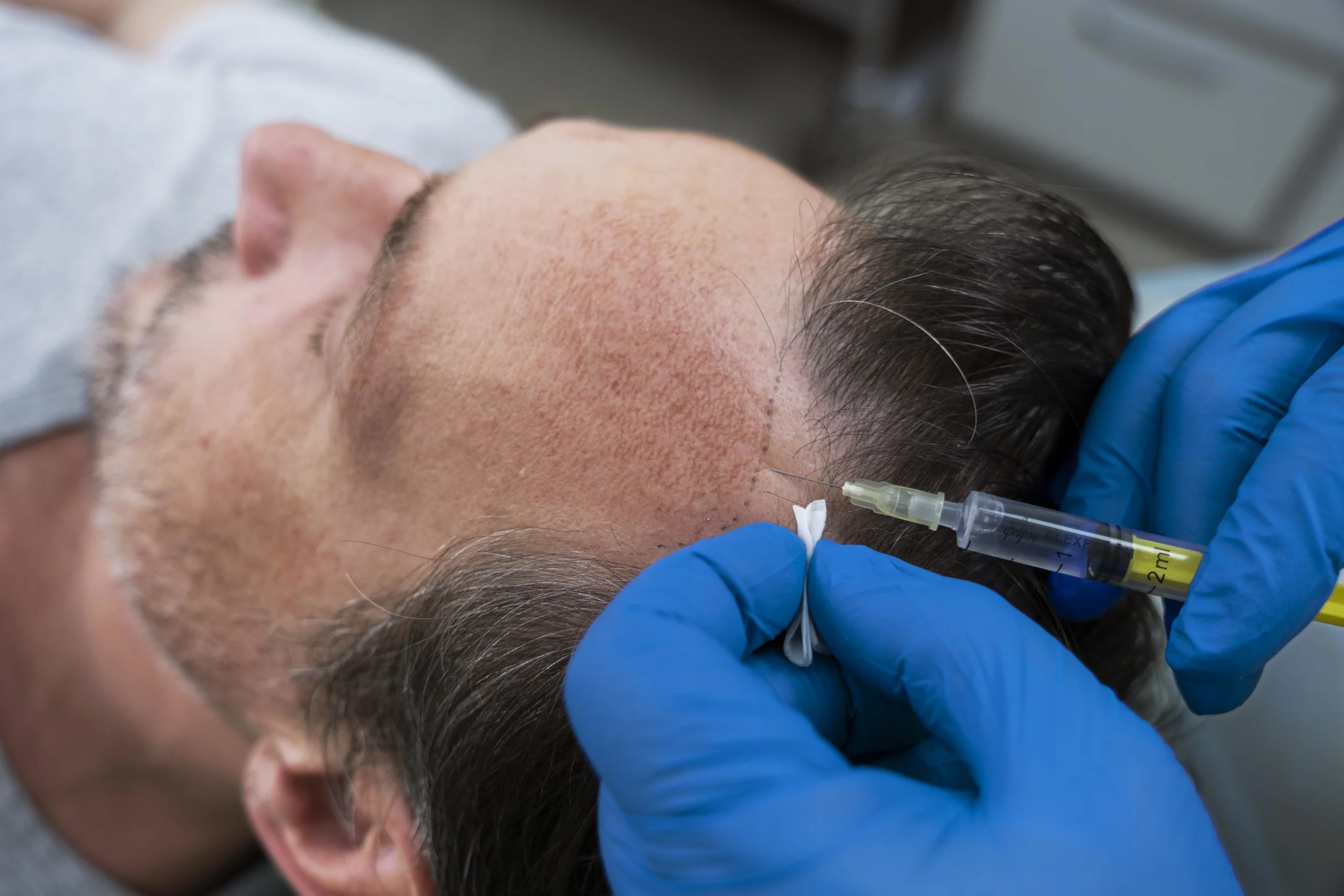 hair loss treatment
