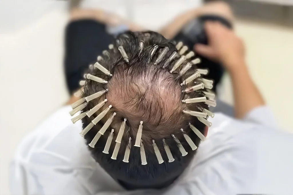 scalp thread treatment